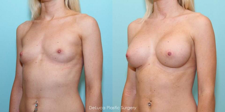 breast-augmentation-350cc-before-after-2.jpg