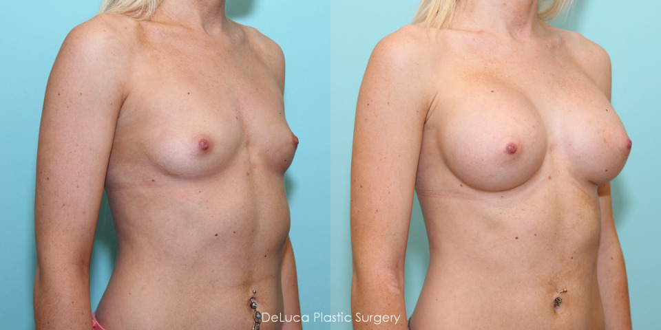 breast-augmentation-350cc-before-after-4.jpg