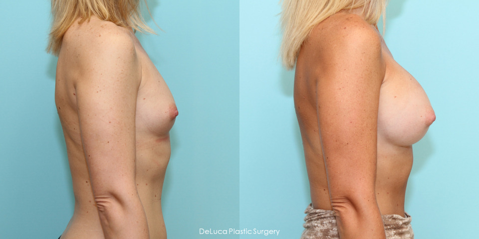 breast-augmentation-350cc-before-after-5.jpg