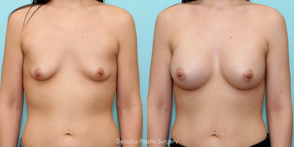 breast-augmentation-375cc-silicone-before-after-1.jpg