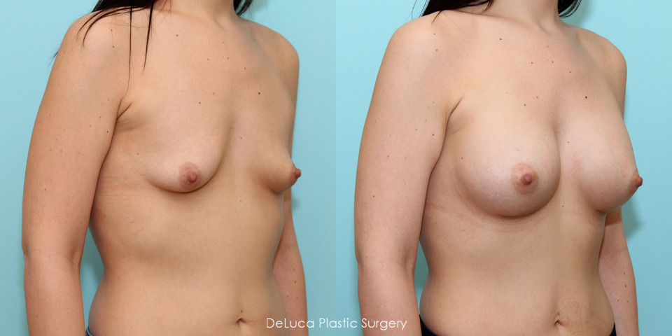 breast-augmentation-375cc-silicone-before-after-4.jpg