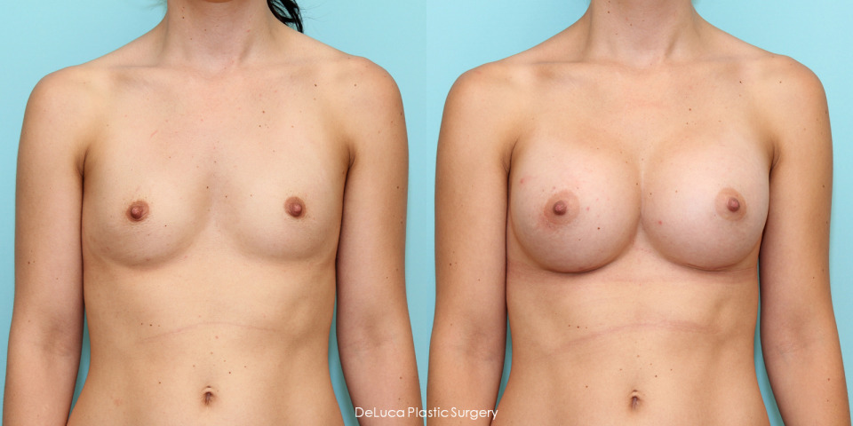 breast-augmentation-425cc-silicone-before-after-1.jpg