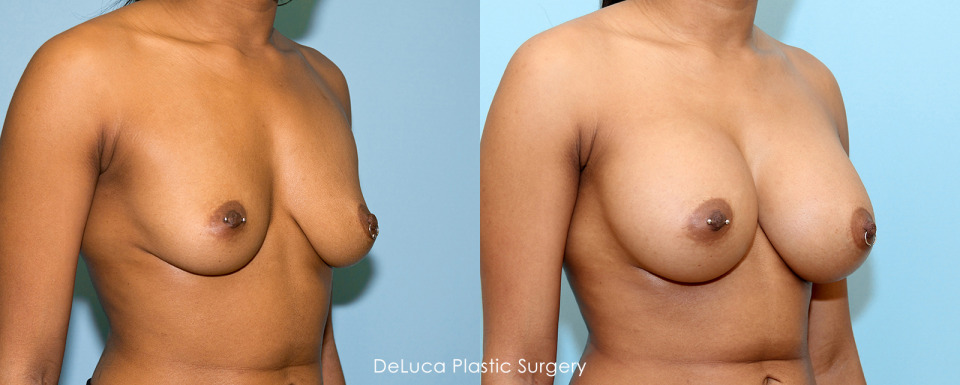 breast-augmentation-475cc-b-to-dd-cup-before-after-2a-1600x.jpg