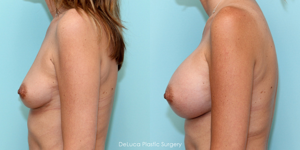 breast-augmentation-475cc-saline-3.jpg