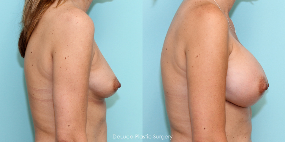 breast-augmentation-475cc-saline-5.jpg