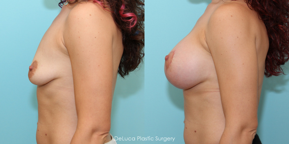 breast-augmentation-550cc-silicone-before-after-3.jpg