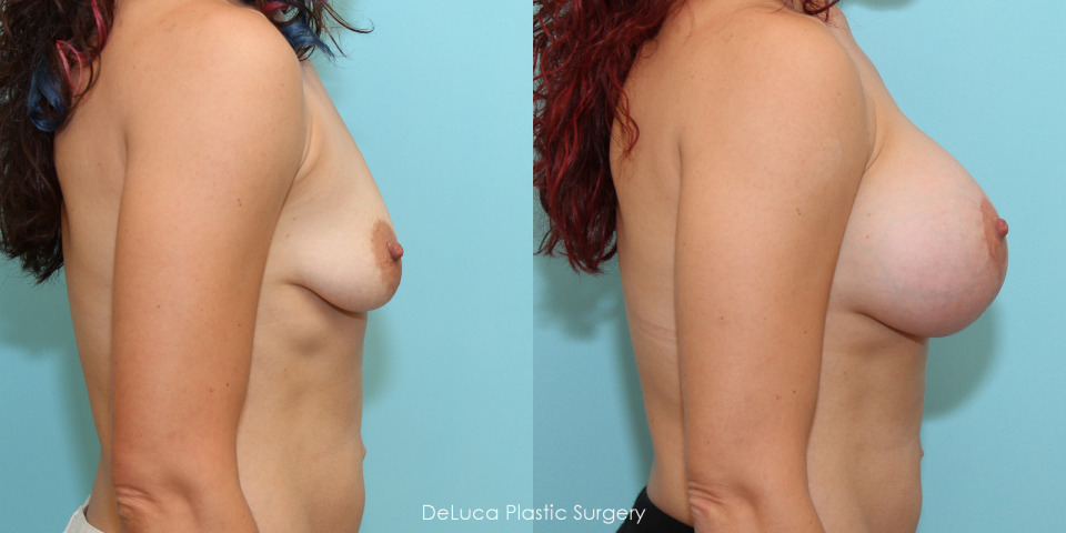 breast-augmentation-550cc-silicone-before-after-5.jpg