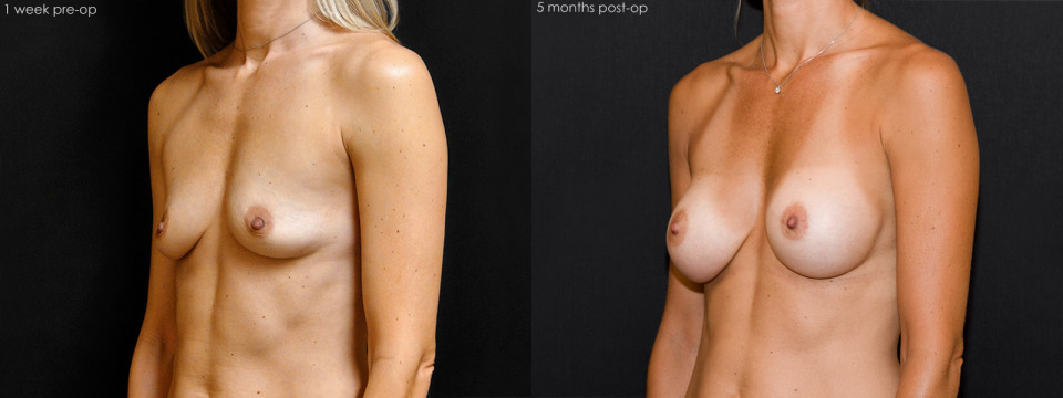 breast-augmentation-albany-b-cup-c-cup-before-after-1a.jpg