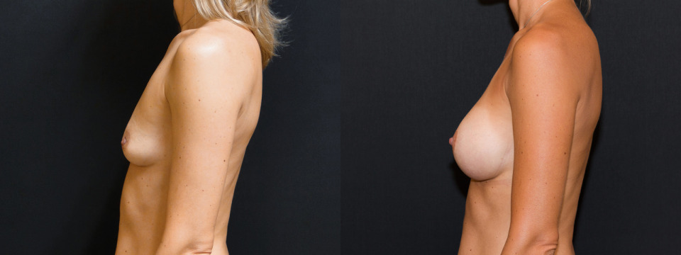 breast-augmentation-albany-b-cup-c-cup-before-after-3a.jpg