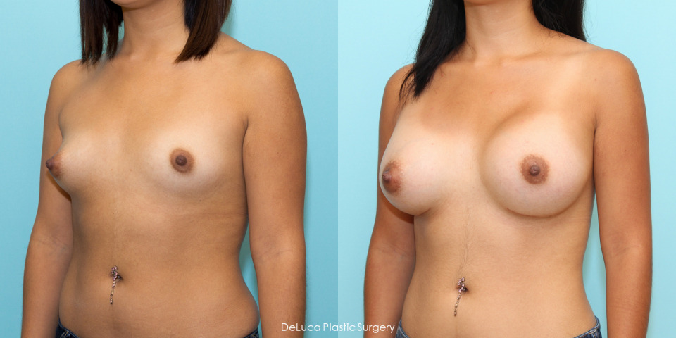 breast-augmentation-before-after-2.jpg