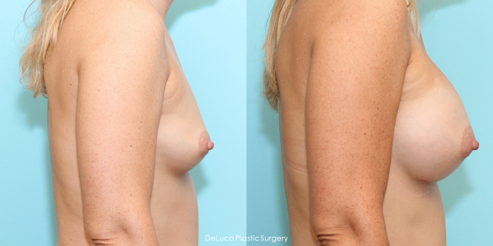 breast-augmentation-before-after-5.jpg