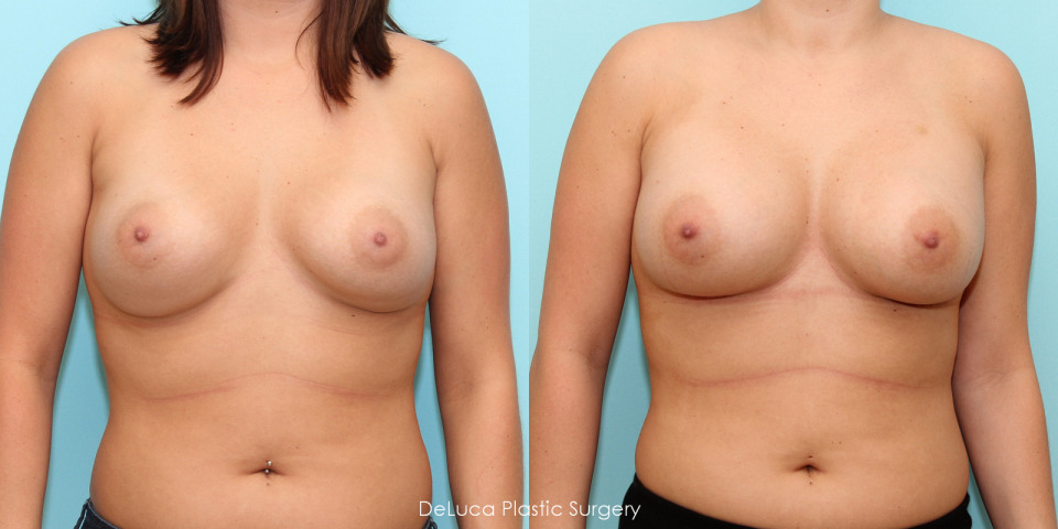 breast-augmentation-before-after-saline-1.jpg