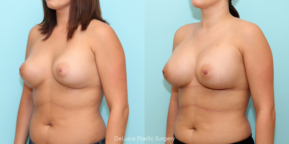 breast-augmentation-before-after-saline-2.jpg