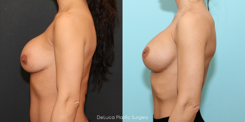 breast-augmentation-implant-change-before-after-3.jpg