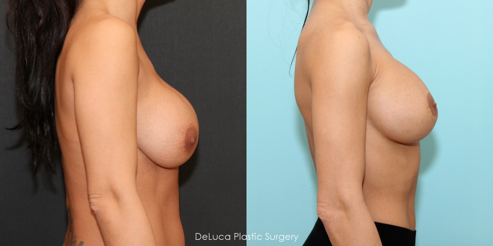breast-augmentation-implant-change-before-after-5.jpg