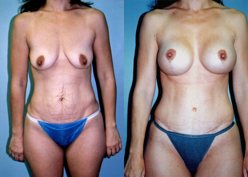 breast-augmentation-tummytuck-beforeafter-1-840x600.jpg