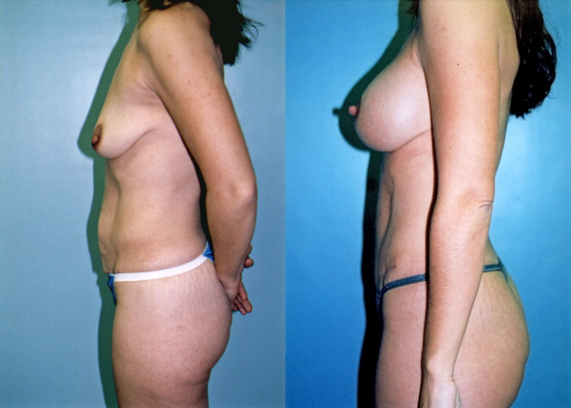 breast-augmentation-tummytuck-beforeafter-3-840x600.jpg
