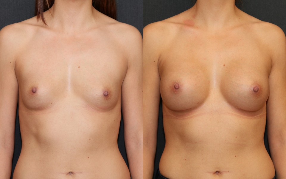 breast-implants-375cc-before-after-1.jpg