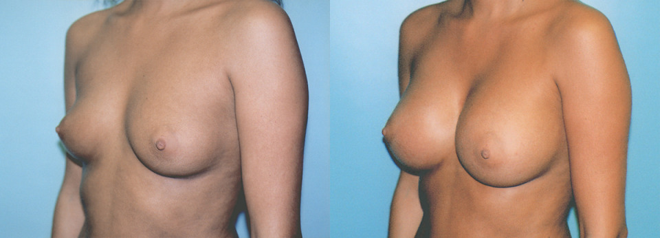 breast-implants-albany-ny-before-after-2.jpg