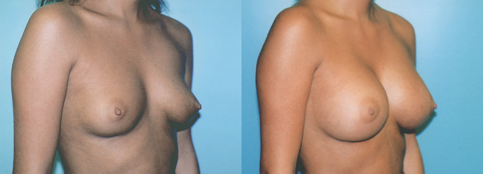 breast-implants-albany-ny-before-after-3.jpg
