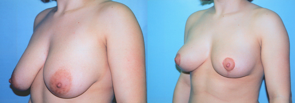 breast-lift-albany-before-after-2-1200x420.jpg