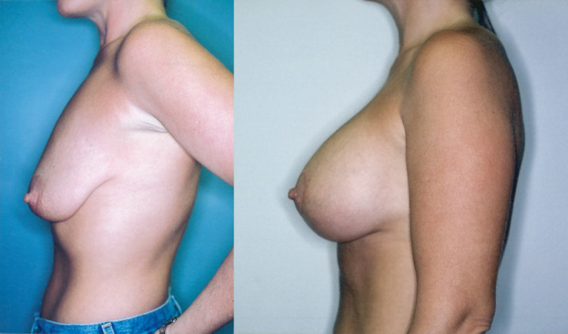 breast-lift-augment-before-after-4a-1020x600.jpg