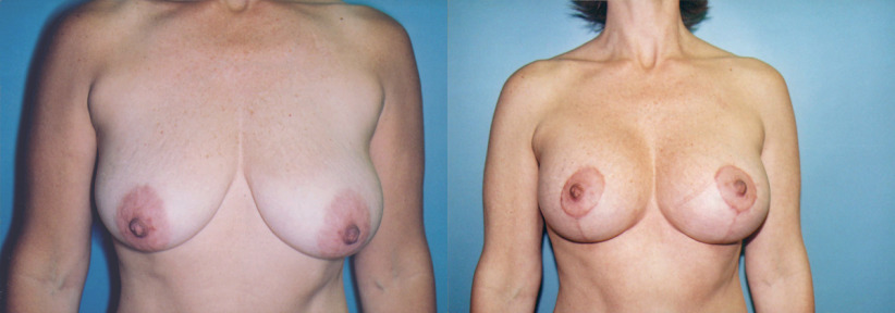 breast-lift-lift-augment-before-after-1-1200x420.jpg