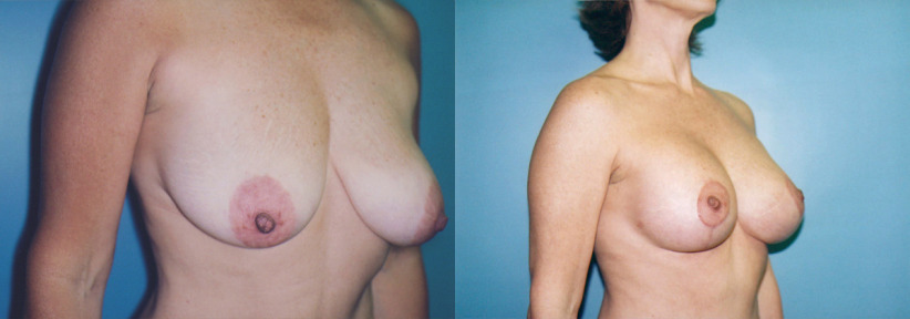 breast-lift-lift-augment-before-after-2-1200x420.jpg