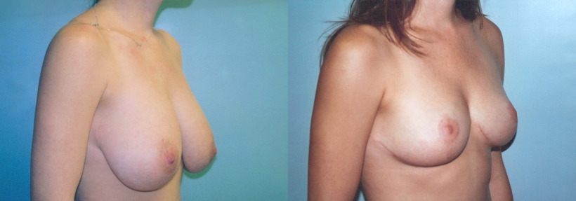 breast-reduction-before-after-2-1200x420.jpg