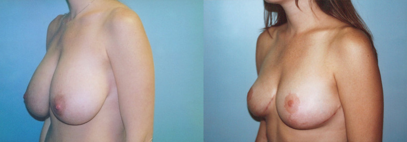 breast-reduction-before-after-3-1200x420.jpg