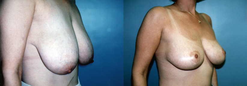 breast-reduction-beforeafter-2-1200x420.jpg