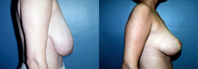 breast-reduction-beforeafter-4-1200x420.jpg