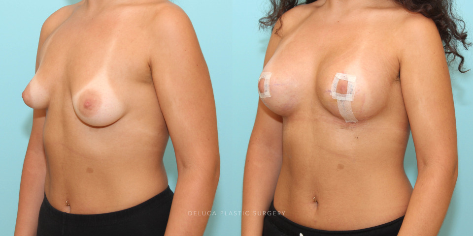 correction of asymmetrical breasts with a tuberous component_2.jpg