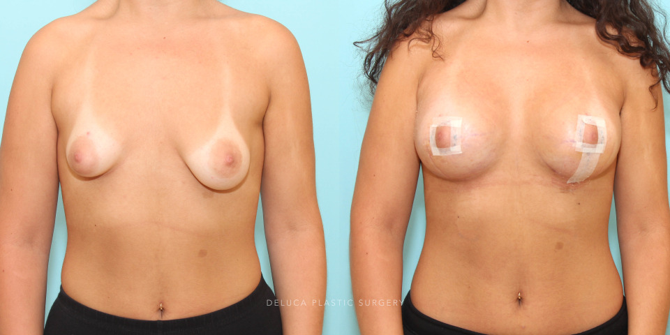 correction of asymmetrical breasts with a tuberous component_3.jpg