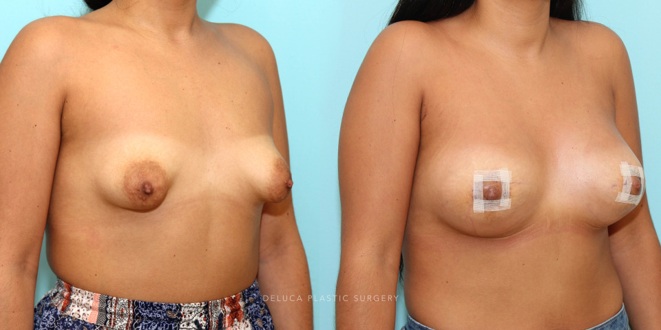 correction of tuberous breasts in a 22 year old young women_4.jpg