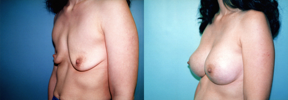 deflated-breast-augmentation-before-after-2.jpg