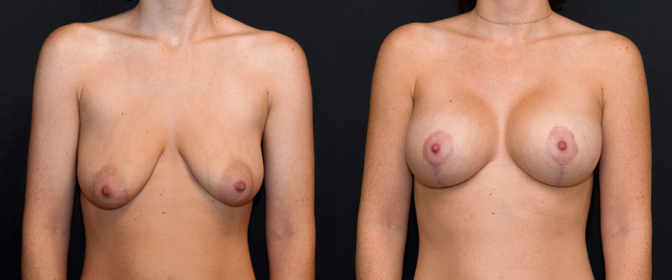 dr-deluca-albany-breast-lift-augmentation-before-after-1.jpg