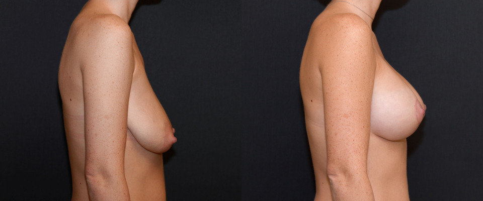 dr-deluca-albany-breast-lift-augmentation-before-after-3.jpg