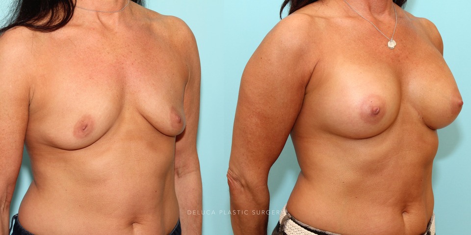 dual-plane breast augmentation with inverted nipple_4.jpg