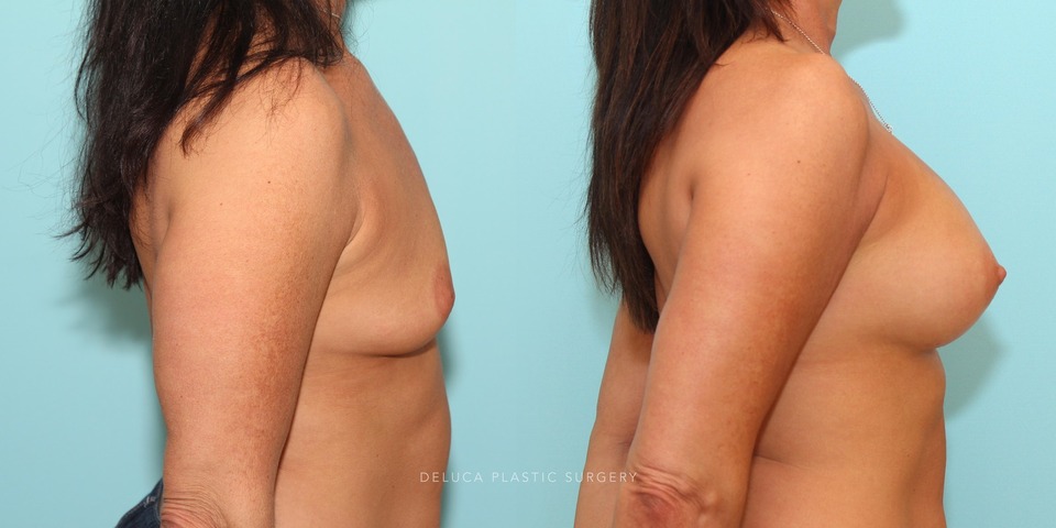 dual-plane breast augmentation with inverted nipple_5.jpg