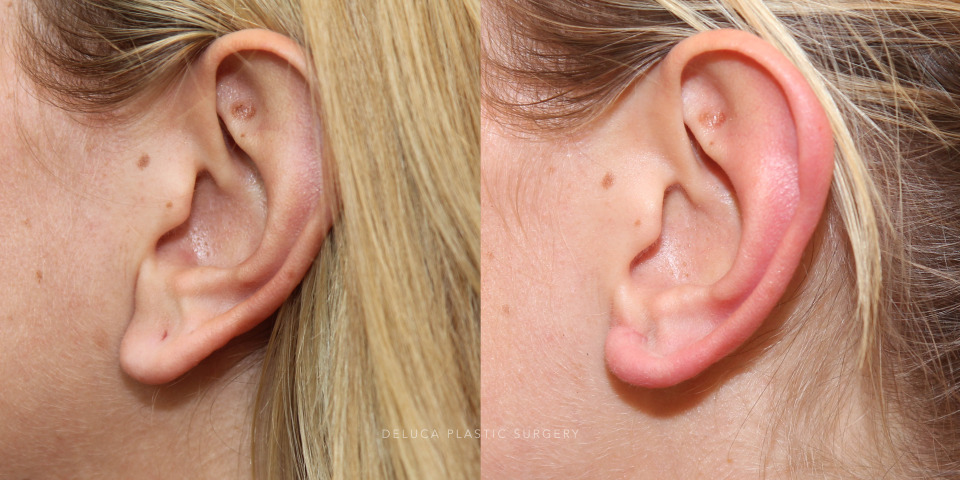 earlobe reduction for prominent earlobes_2.jpg