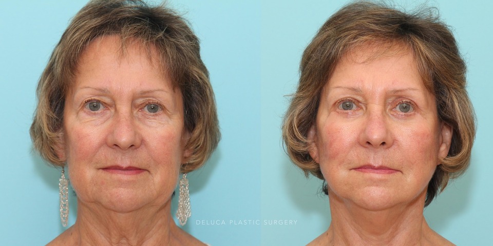 face and neck lift fata grafting to the cheeks and upper and lower lid blepharoplasty_3.jpg