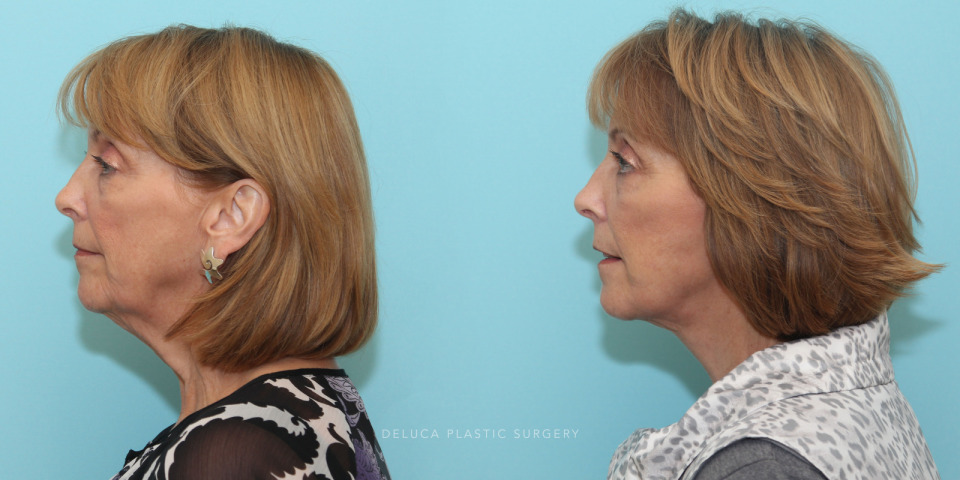 face and neck lift with lower lid blepharoplasty_1.jpg