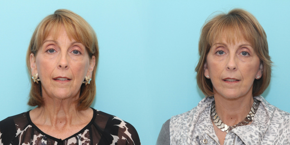 face and neck lift with lower lid blepharoplasty_3.jpg