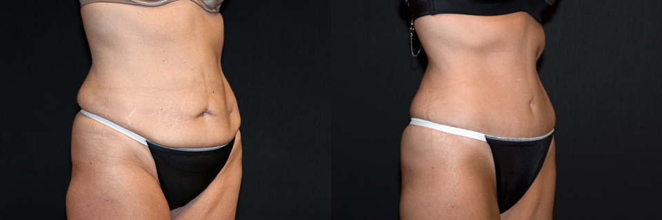 full-tummy-tuck-abdominoplasty-before-after-2.jpg