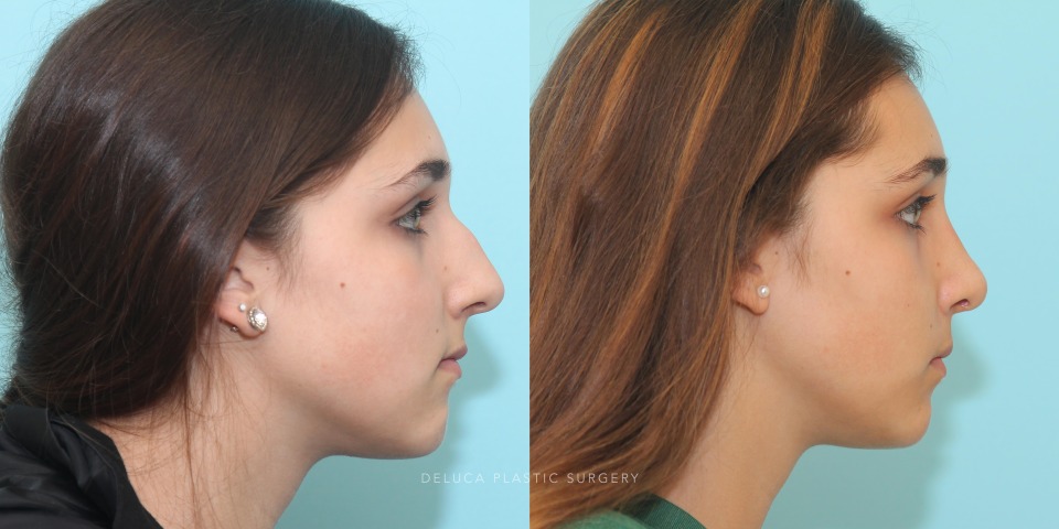 functional septorhinoplasty for nasal obstruction_5.jpg