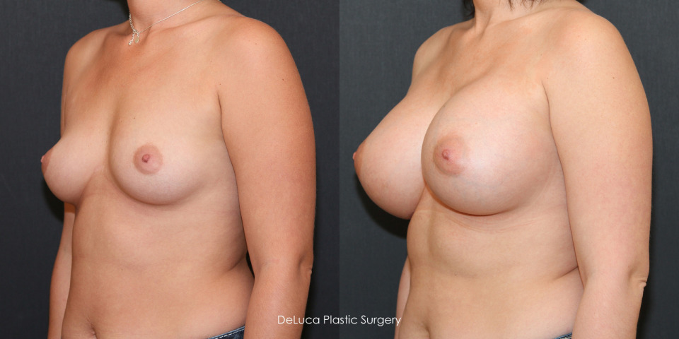 large-breast-augmentation-650cc-high-profile-before-after-2.jpg