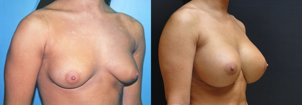 large-breast-augmentation-albany-before-after-2.jpg