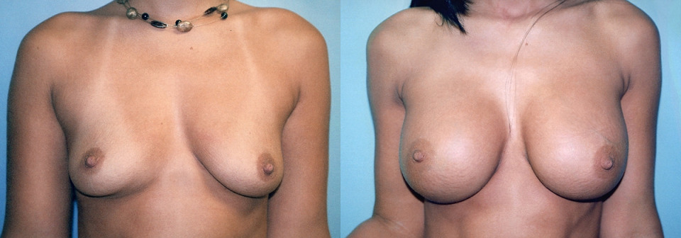 large-breast-implants-albany-before-after-1.jpg