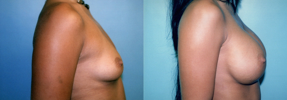 large-breast-implants-albany-before-after-4.jpg